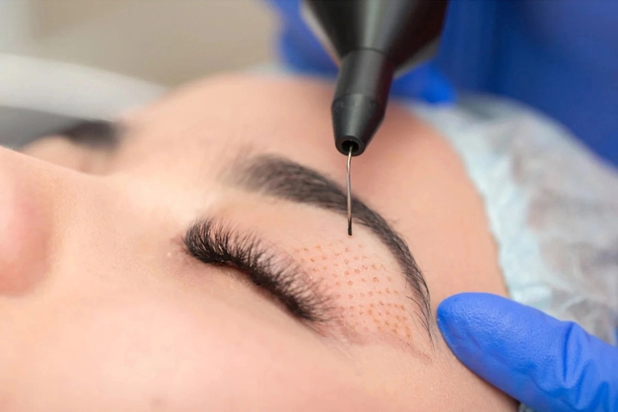 Eyelid Lift Image