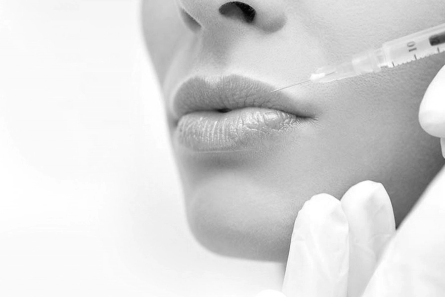 Lip Fillers Image