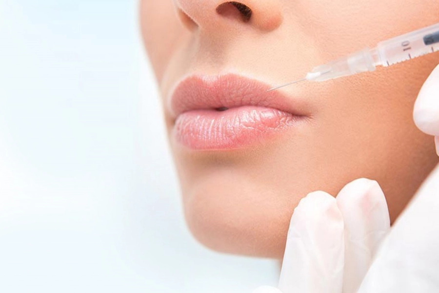 Lip Fillers Image