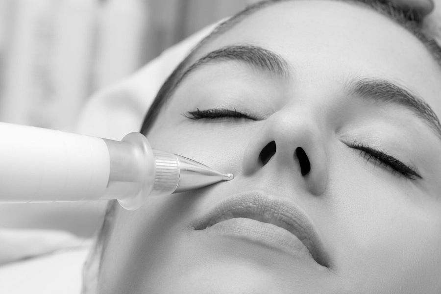 Lip Lift Image