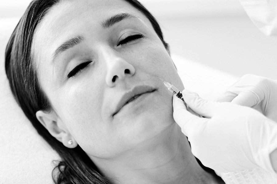 Nasolabial Folds Filler Image