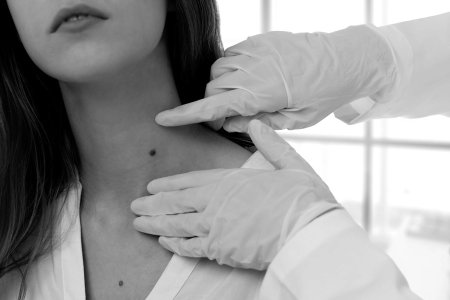 Skin Tag Removal Image