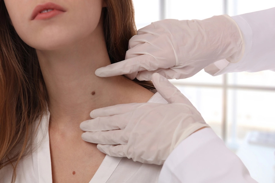 Skin Tag Removal Image