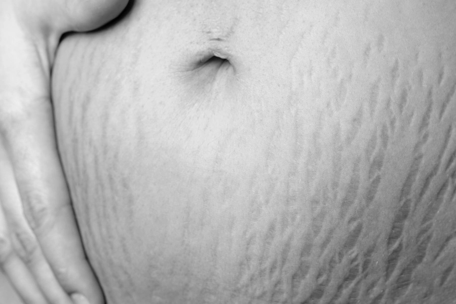 Stretch Marks Image
