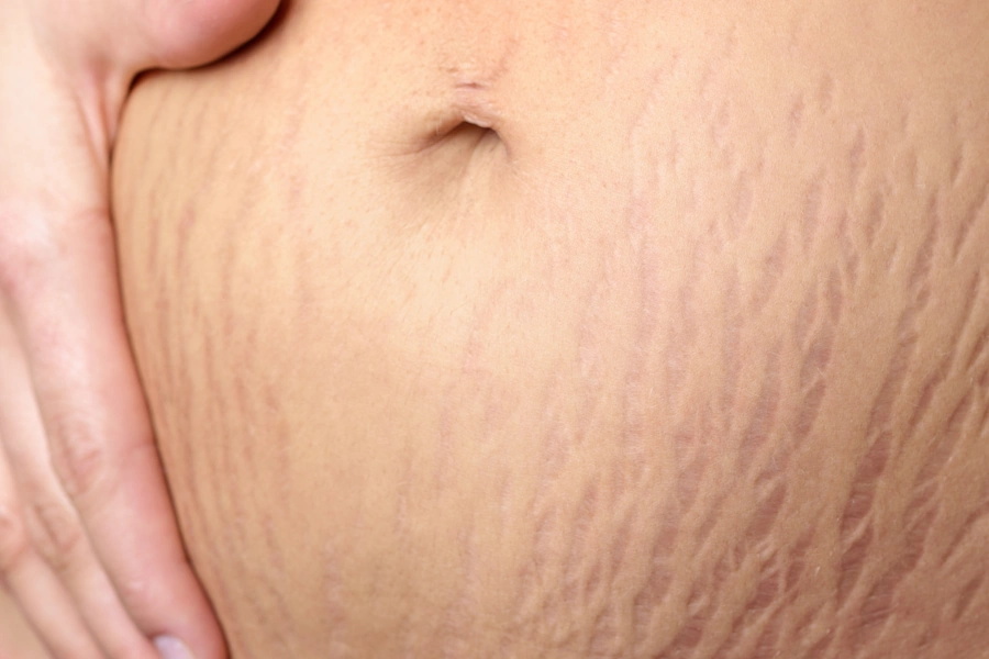Stretch Marks Image